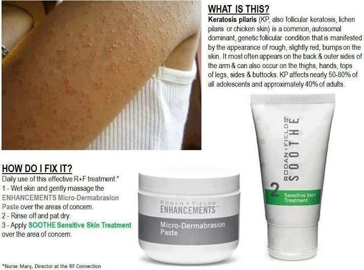 Suffering from Keratosis Pilaris? Ive got the perfect product.. Rodan and Fields