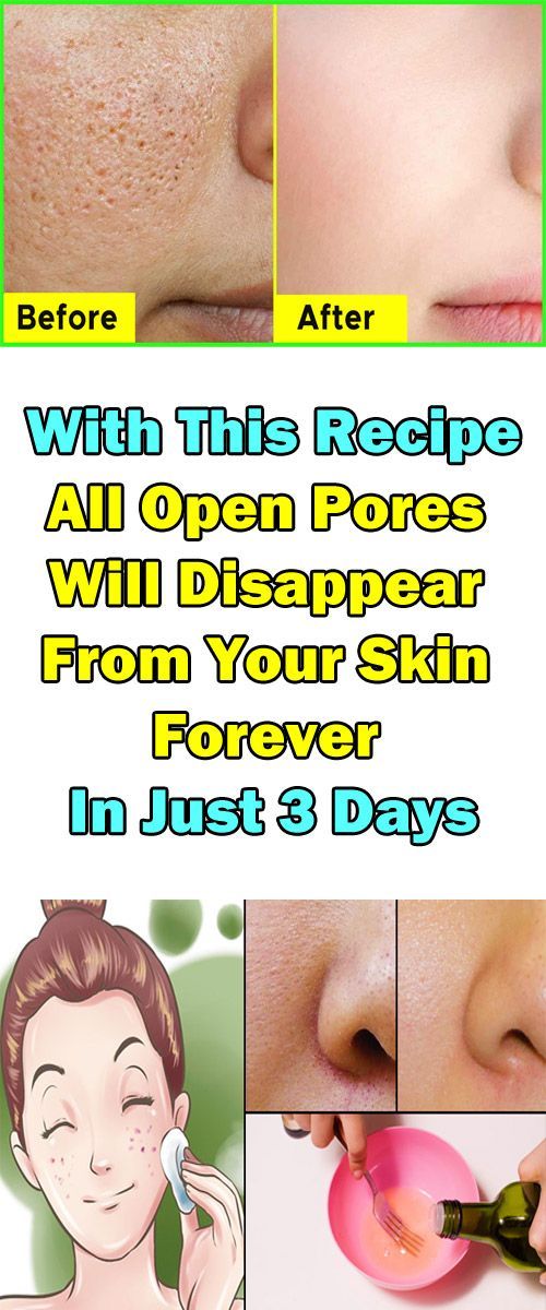 All Open Pores Will Disappear From Your Skin Forever In Just 3 Days! - All Open Pores Will Disappear From Your Skin Forever In Just 3 Days! -   7 diy Face Mask for pores ideas