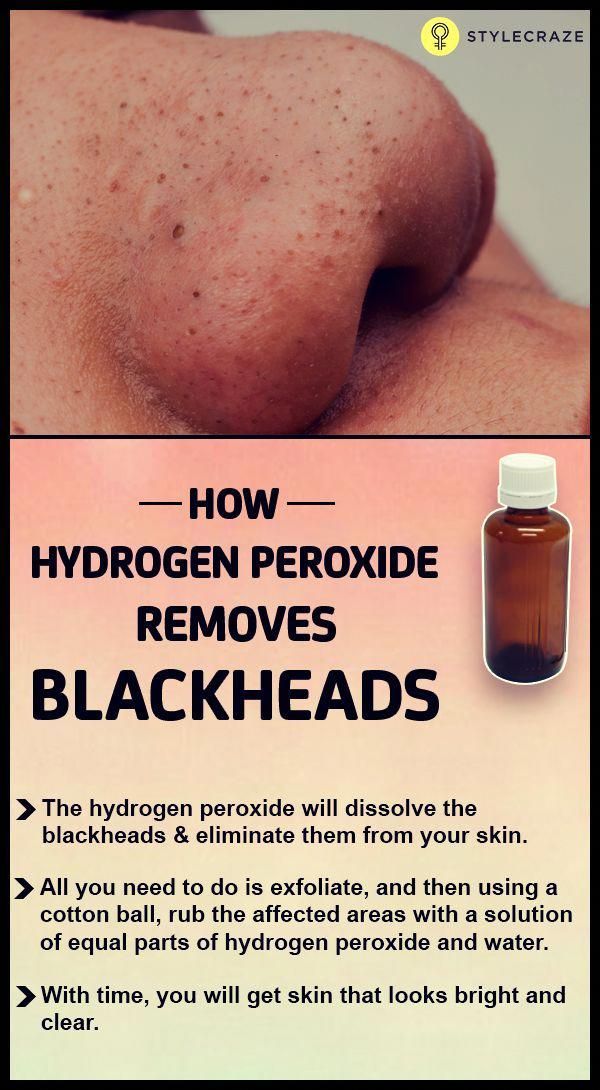 How To Use Hydrogen Peroxide To Remove Blackheads? - How To Use Hydrogen Peroxide To Remove Blackheads? -   13 beauty Hacks remedies ideas