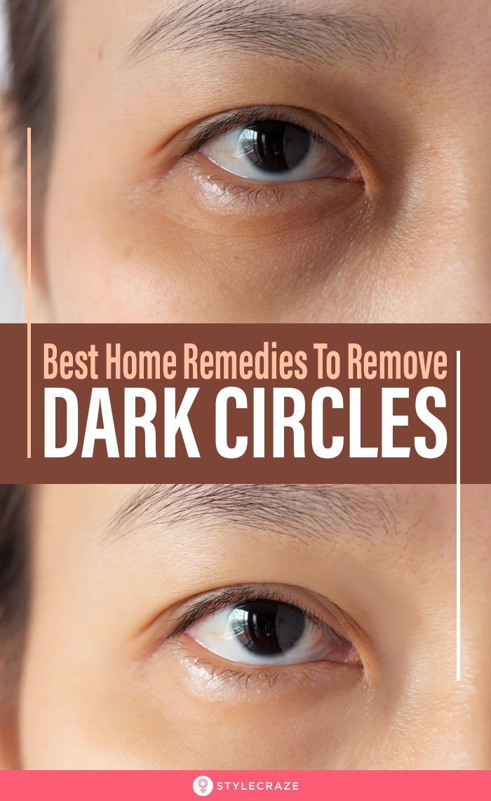 9 beauty Tips for dark circles ideas