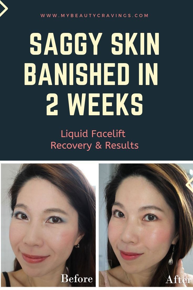 Review: Astute Medical Centre tightened my Saggy Skin with its Facial Harmony Program (Part 2 - Recovery & Results) » myBeautyCravings - Review: Astute Medical Centre tightened my Saggy Skin with its Facial Harmony Program (Part 2 - Recovery & Results) » myBeautyCravings -   11 beauty Treatments aesthetic ideas