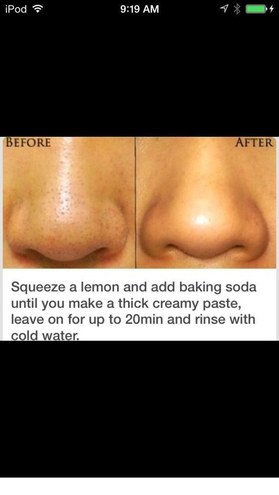 blackhead Remover- Best natural Product ways to Remove acne for Good | LANBENA™ - blackhead Remover- Best natural Product ways to Remove acne for Good | LANBENA™ -   16 healthy beauty Tips ideas
