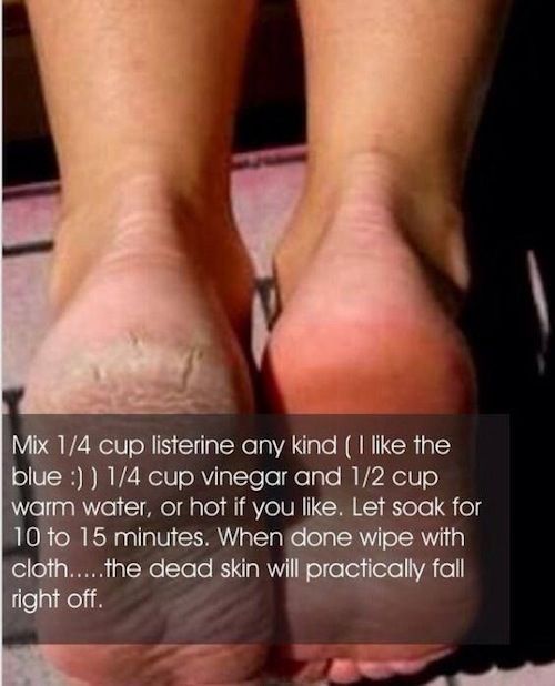 Dry Cracked Feet, and How to Fix Them - Dry Cracked Feet, and How to Fix Them -   15 beauty Hacks feet ideas