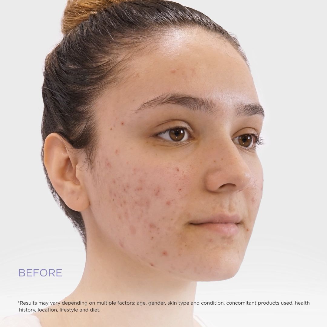 New SPOTLESS acne 2-step treatment for teens and young adults - New SPOTLESS acne 2-step treatment for teens and young adults -   12 beauty Treatments poster ideas