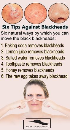 Six Tips Against Blackheads.Blackheads Can Be A Challenge For Skin - Six Tips Against Blackheads.Blackheads Can Be A Challenge For Skin -   18 homemade beauty Tips ideas