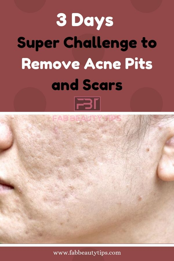 Remove Acne Scars in 3 Days with this Home Remedy | Fab Beauty Tips - Remove Acne Scars in 3 Days with this Home Remedy | Fab Beauty Tips -   17 beauty Tips for acne ideas