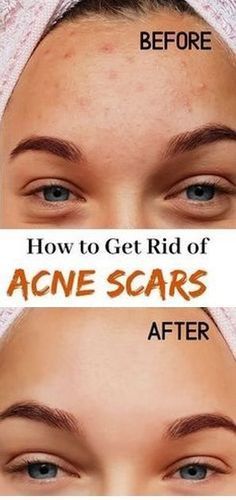 14 Home Remedies For Acne Scars That Actually Work - 14 Home Remedies For Acne Scars That Actually Work -   17 beauty Tips for acne ideas