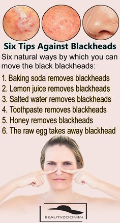 Six Tips Against Blackheads.Blackheads Can Be A Challenge For Skin - Six Tips Against Blackheads.Blackheads Can Be A Challenge For Skin -   18 beauty Skin people ideas