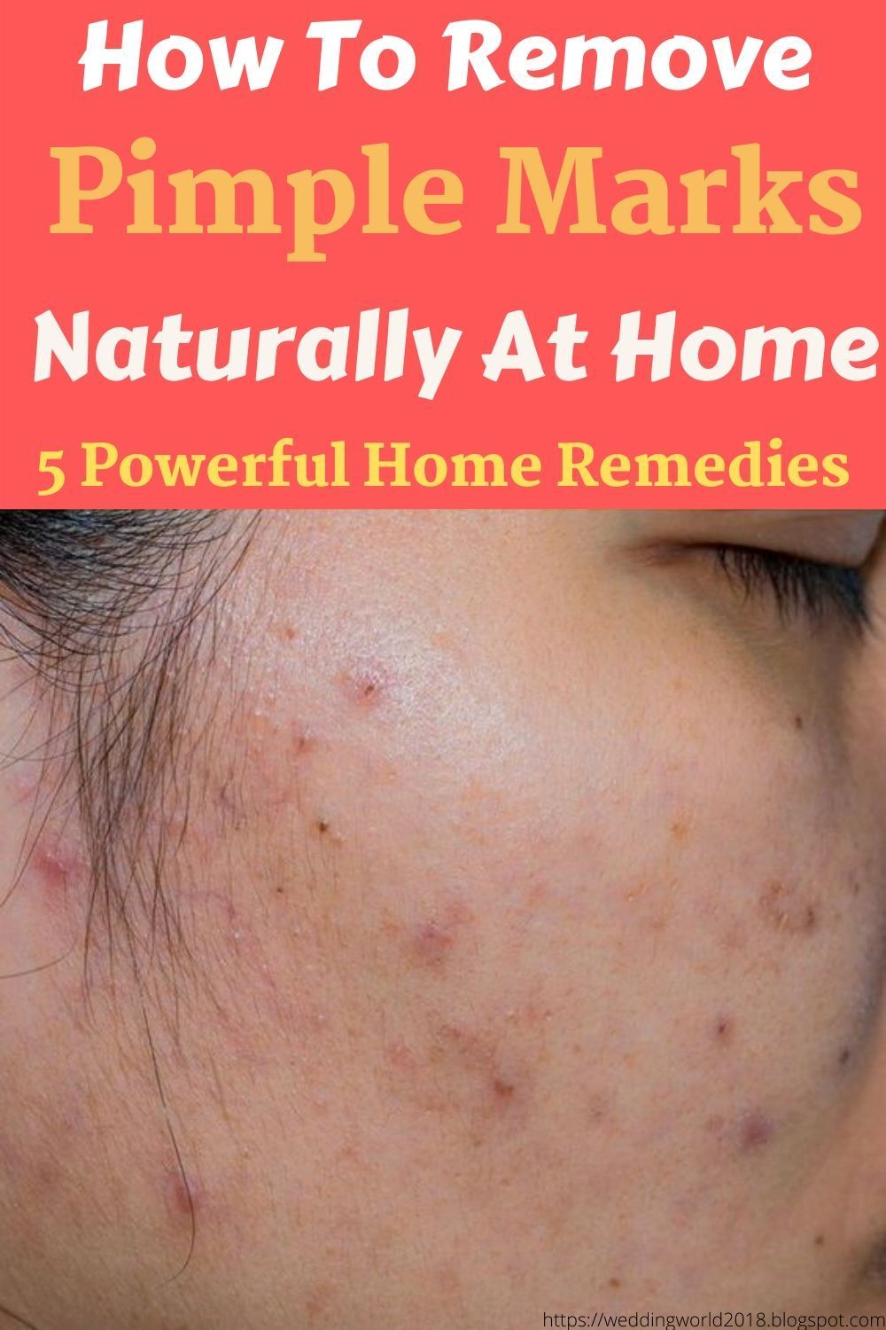 How To Remove Pimple Marks Naturally At Home - 5 Powerful Home Remedies - How To Remove Pimple Marks Naturally At Home - 5 Powerful Home Remedies -   18 beauty Treatments pimples ideas