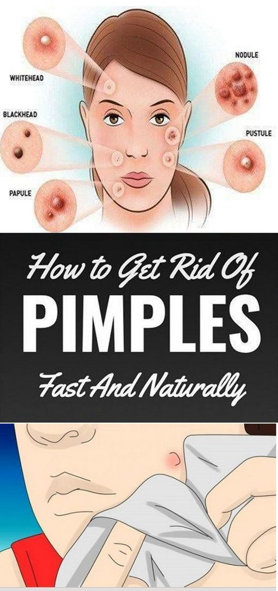 How To Get Rid Of Pimples (Acne) Overnight Fast - How To Get Rid Of Pimples (Acne) Overnight Fast -   18 beauty Treatments pimples ideas