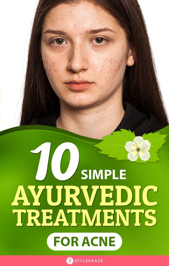 10 Simple Ayurvedic Treatments For Acne - 10 Simple Ayurvedic Treatments For Acne -   18 beauty Treatments pimples ideas