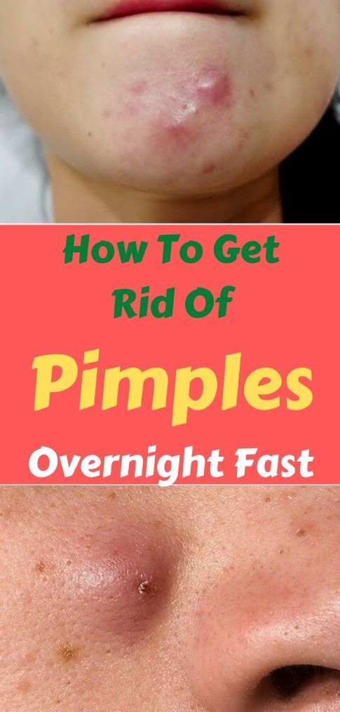 How To Get Rid of a Pimple Overnight Fast - How To Get Rid of a Pimple Overnight Fast -   18 beauty Treatments pimples ideas