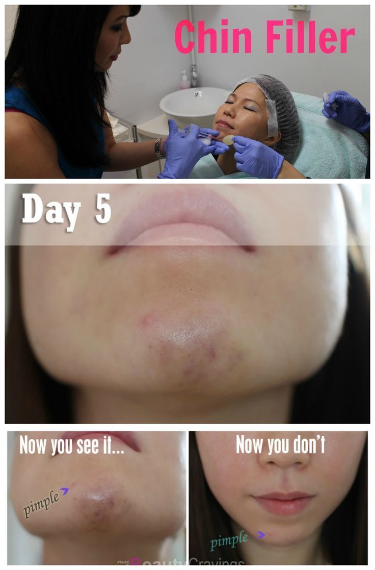 Chin Filler Treatment by Cutis Medical Laser Clinics | Part 3 - The Recovery » myBeautyCravings - Chin Filler Treatment by Cutis Medical Laser Clinics | Part 3 - The Recovery » myBeautyCravings -   18 medical beauty Treatments ideas