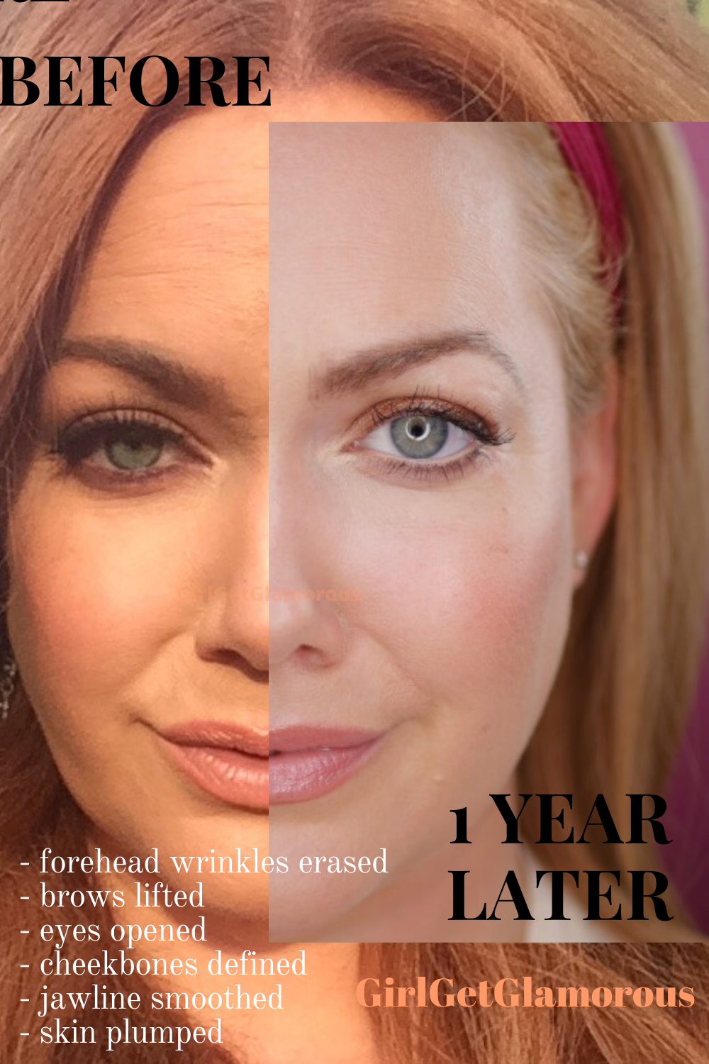 Before + After ZIIP Beauty - Before + After ZIIP Beauty -   19 beauty Treatments how to use ideas