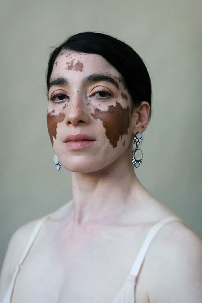35 Beautiful Women With Vitiligo Shot By A Photographer Who Has The Same Condition - 35 Beautiful Women With Vitiligo Shot By A Photographer Who Has The Same Condition -   19 beauty Photography ideas
