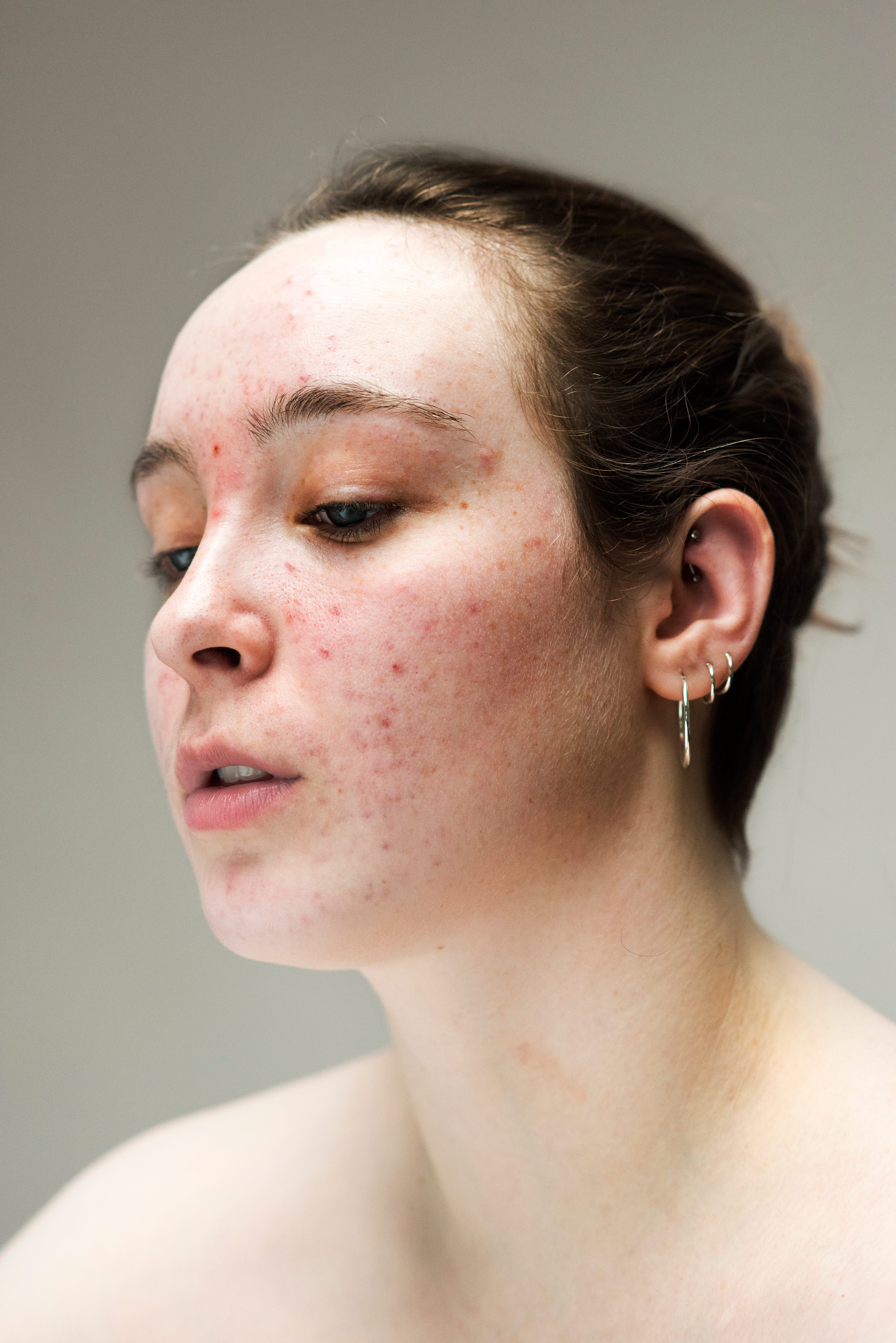 The Raw Beauty Of Women With Acne, Eczema & Hyperpigmentation - The Raw Beauty Of Women With Acne, Eczema & Hyperpigmentation -   19 beauty Photography people ideas